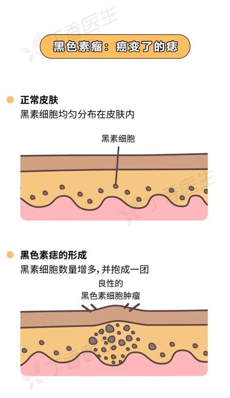 大痣|痣也可能会癌变！长在 3 个地方要注意